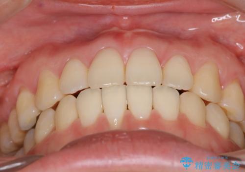 上下の前歯がかめない インビザライン矯正で正しいかみ合わせへの治療後