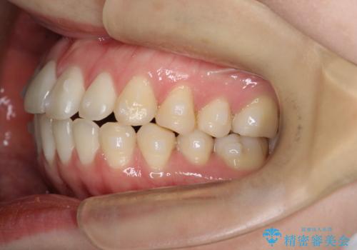 上下の前歯がかめない インビザライン矯正で正しいかみ合わせへの治療中