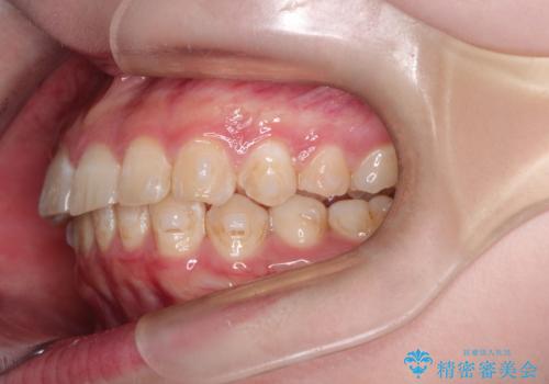 インビザラインで前歯のガタガタをきれいな歯並びへの治療中