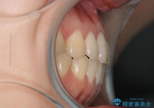 上下の前歯がかめない インビザライン矯正で正しいかみ合わせへの治療後