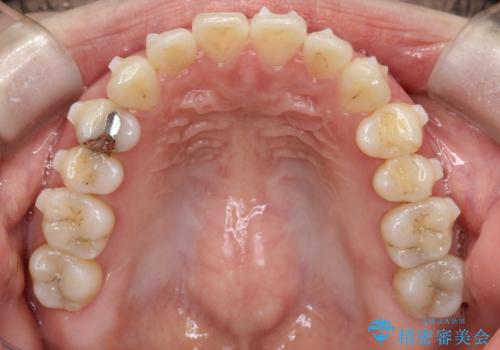 上下の前歯がかめない インビザライン矯正で正しいかみ合わせへの治療中