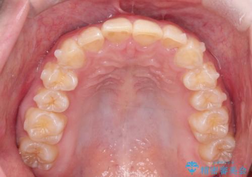 インビザラインで前歯のガタガタをきれいな歯並びへの治療中
