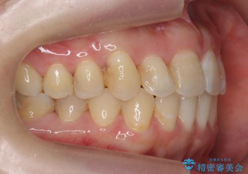 犬歯のねじれ　上の歯が引っ込んでいるの治療後