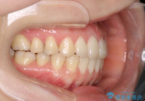 上下の前歯がかめない インビザライン矯正で正しいかみ合わせへの治療後