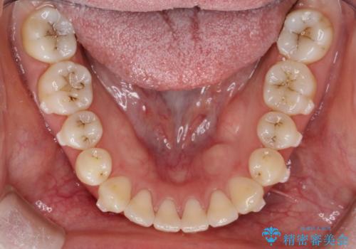 上下の前歯がかめない インビザライン矯正で正しいかみ合わせへの治療中