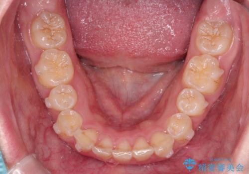 インビザラインで前歯のガタガタをきれいな歯並びへの治療中