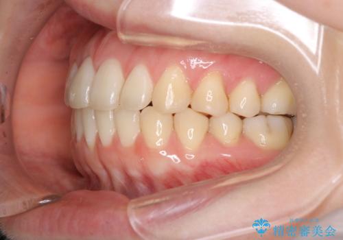 上下の前歯がかめない インビザライン矯正で正しいかみ合わせへの治療後