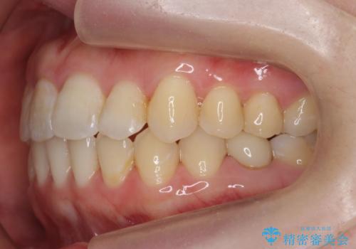 犬歯のねじれ 上の歯が引っ込んでいるの治療後