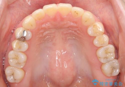 上下の前歯がかめない インビザライン矯正で正しいかみ合わせへの治療後