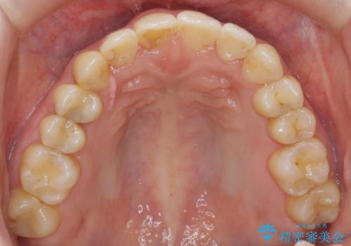 犬歯のねじれ 上の歯が引っ込んでいるの治療後