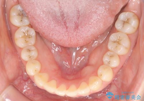 上下の前歯がかめない インビザライン矯正で正しいかみ合わせへの治療後