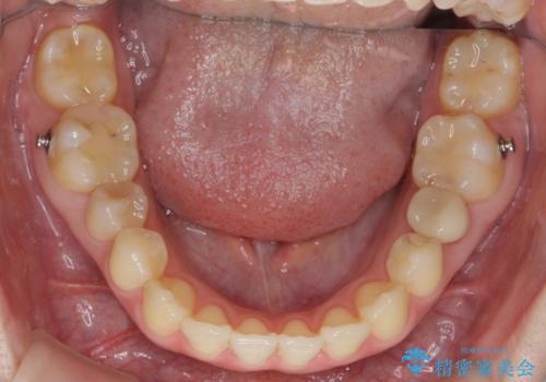 犬歯のねじれ 上の歯が引っ込んでいるの治療後