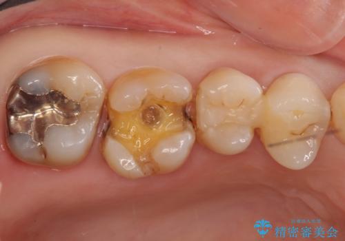 銀歯を白く　虫歯治療の治療中