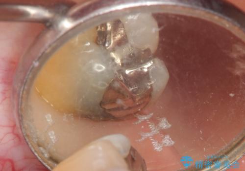 銀歯を白く 虫歯治療の治療前