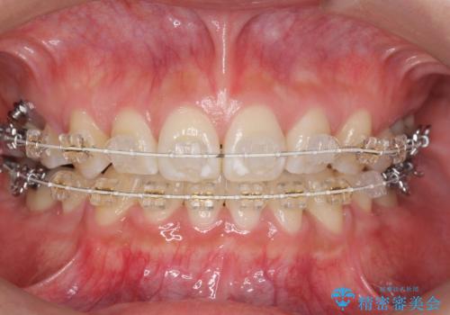 真ん中が右にずれている 前歯のがたつき 治療途中に地方へ引っ越したが、通ってワイヤー矯正の治療中