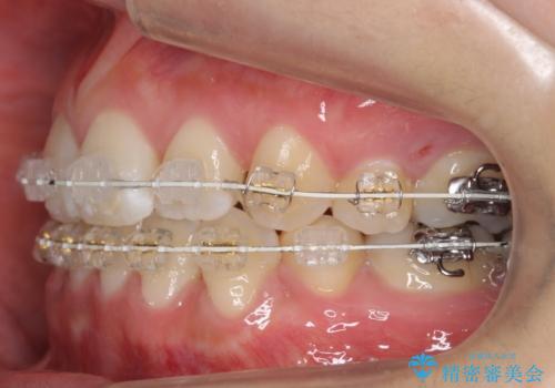 真ん中が右にずれている　前歯のがたつき　治療途中に地方へ引っ越したが、通ってワイヤー矯正の治療中