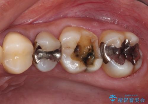 治療中放置してしまった奥歯 セラミック治療の治療前