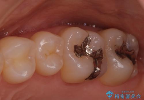 目立つ銀歯を白くしたい　セラミック治療の治療前