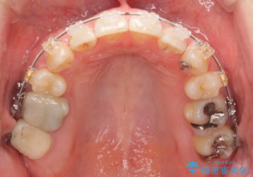 真ん中が右にずれている 前歯のがたつき 治療途中に地方へ引っ越したが、通ってワイヤー矯正の治療中
