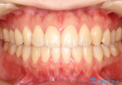 インビザラインによる再矯正症例の症例 治療後