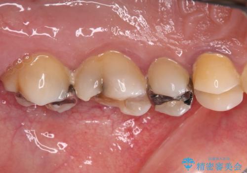 治療中放置してしまった奥歯 セラミック治療の治療前