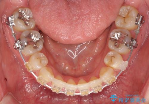 真ん中が右にずれている 前歯のがたつき 治療途中に地方へ引っ越したが、通ってワイヤー矯正の治療中