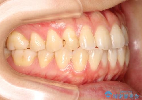 インビザラインによる再矯正症例の治療前