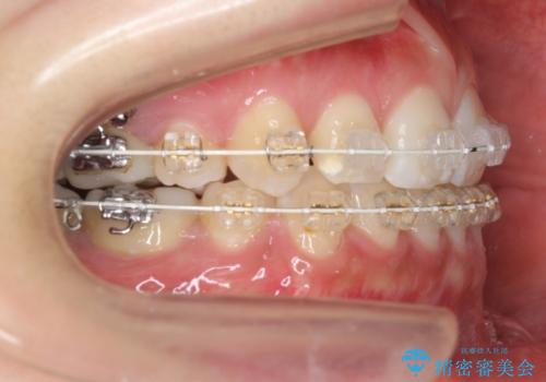 真ん中が右にずれている 前歯のがたつき 治療途中に地方へ引っ越したが、通ってワイヤー矯正の治療中