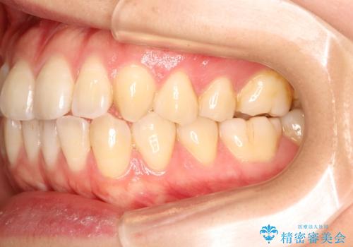 インビザラインによる再矯正症例の治療前