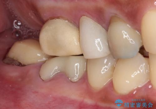 治療中放置してしまった奥歯 セラミック治療の治療前