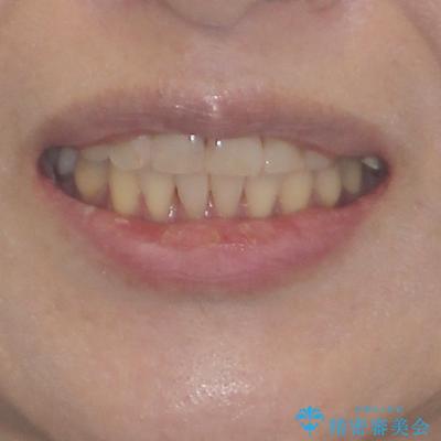 インビザラインは面倒くさい 目立たないワイヤー装置による矯正治療の治療後(顔貌)