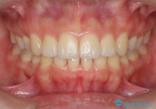 再矯正 昔ワイヤーで治療 前歯の並びを再度きれいにの治療中