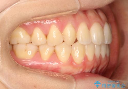 インビザラインによる再矯正症例の治療後