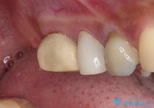 治療中放置してしまった奥歯 セラミック治療の治療前