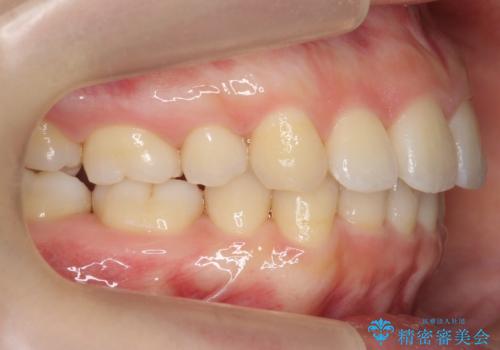 再矯正 昔ワイヤーで治療 前歯の並びを再度きれいにの治療中