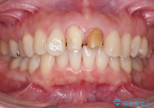 変色した前歯をセラミックでひっこめたい の治療中