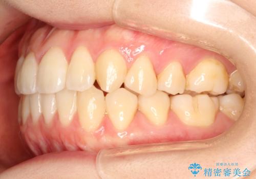 インビザラインによる再矯正症例の治療後