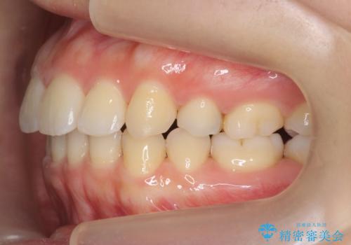 再矯正 昔ワイヤーで治療 前歯の並びを再度きれいにの治療中