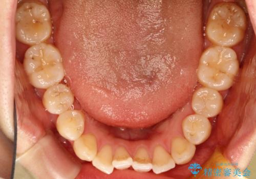 インビザラインによる再矯正症例の治療前