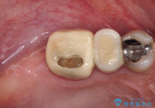 治療中放置してしまった奥歯 セラミック治療の治療前