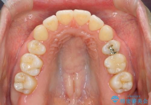再矯正 昔ワイヤーで治療 前歯の並びを再度きれいにの治療中