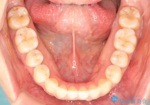 インビザラインによる再矯正症例の治療後