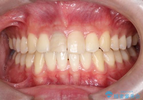 【ホワイトニング】右上前歯の歯茎の辺りが暗いのが気になる。の治療前