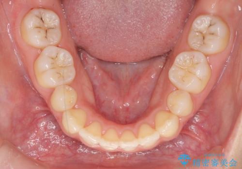 再矯正 昔ワイヤーで治療 前歯の並びを再度きれいにの治療中