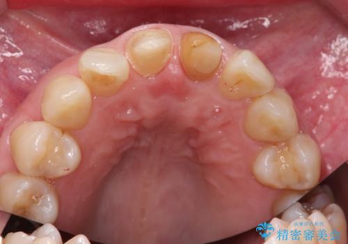 変色した前歯をセラミックでひっこめたい の治療中