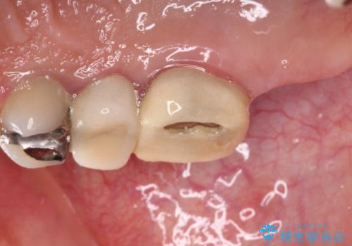 治療中放置してしまった奥歯 セラミック治療の治療前