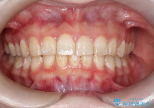 インビザラインで前歯のガタガタをきれいな歯並びへの治療後