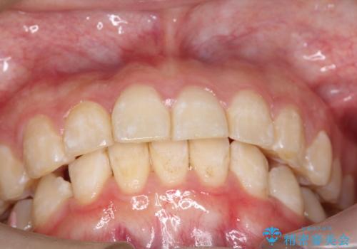 インビザラインで前歯のガタガタをきれいな歯並びへの治療後