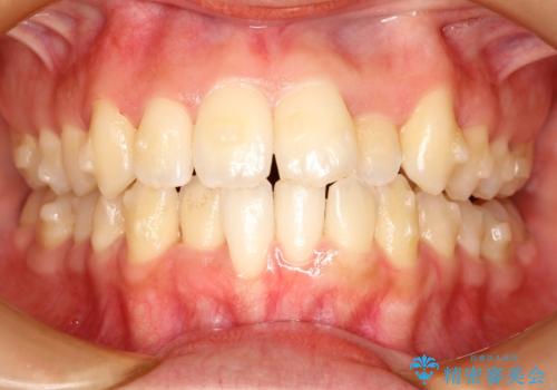 コンプレックスだった・・・唇が閉じなかった口元。綺麗になりました。の治療中