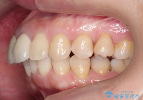 変色した前歯をセラミックでひっこめたい の治療後
